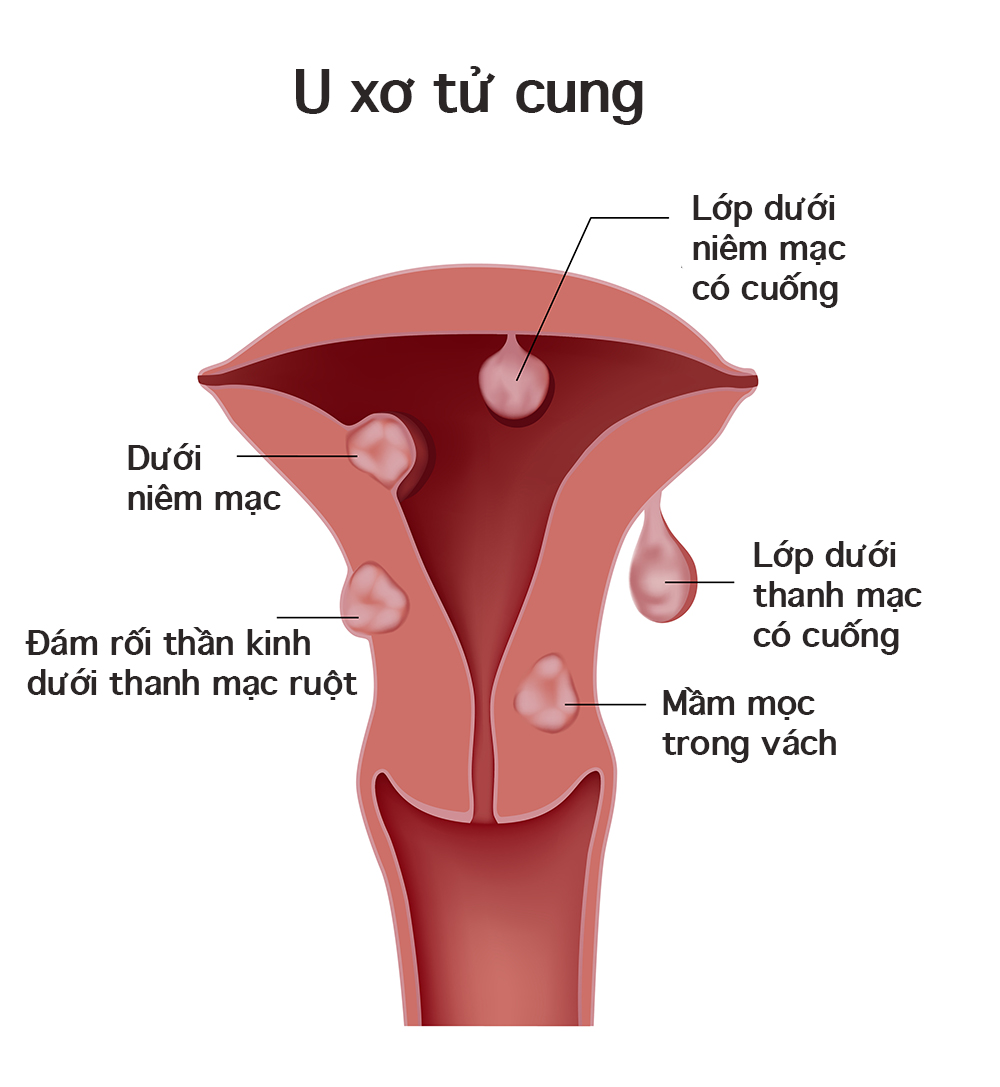 ác bệnh phụ khoa thường gặp ở nữ giới: U xơ tử cung