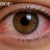 Bệnh khô mắt phải làm sao? 7 cách giúp mắt dễ chịu hơn